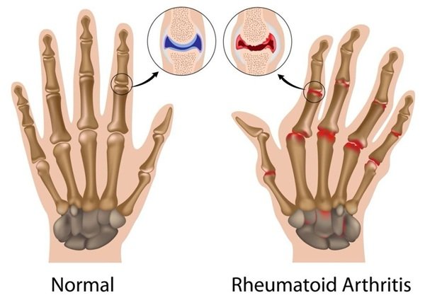 ROMATOİD ARTRİT